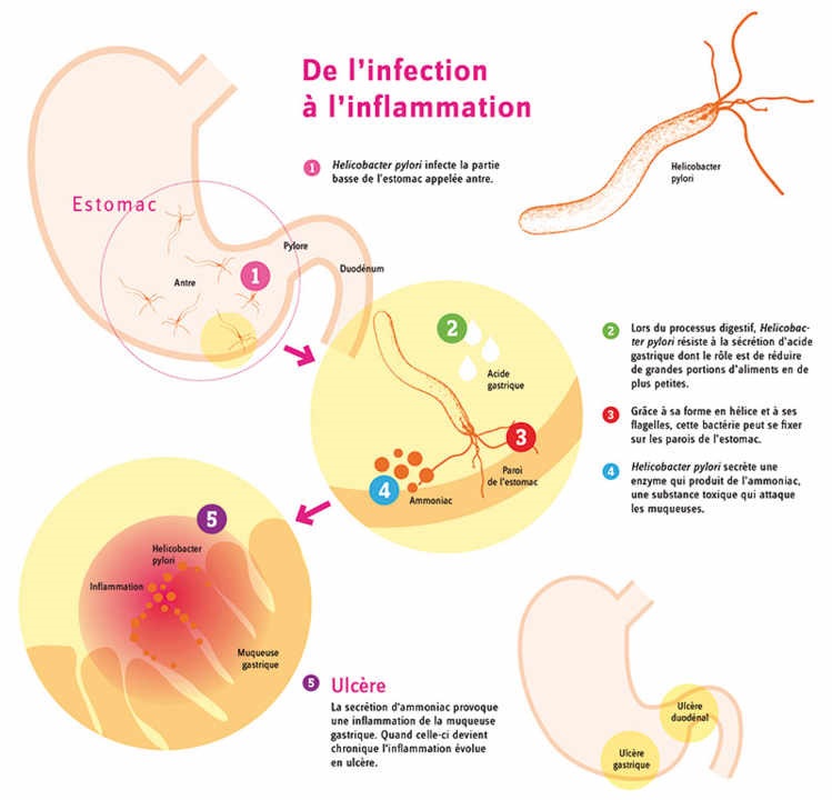 Hélicobacter pylori